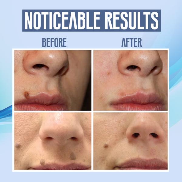 BowLift | SpotErase™ Perfect Spot Solution in Just Few Weeks