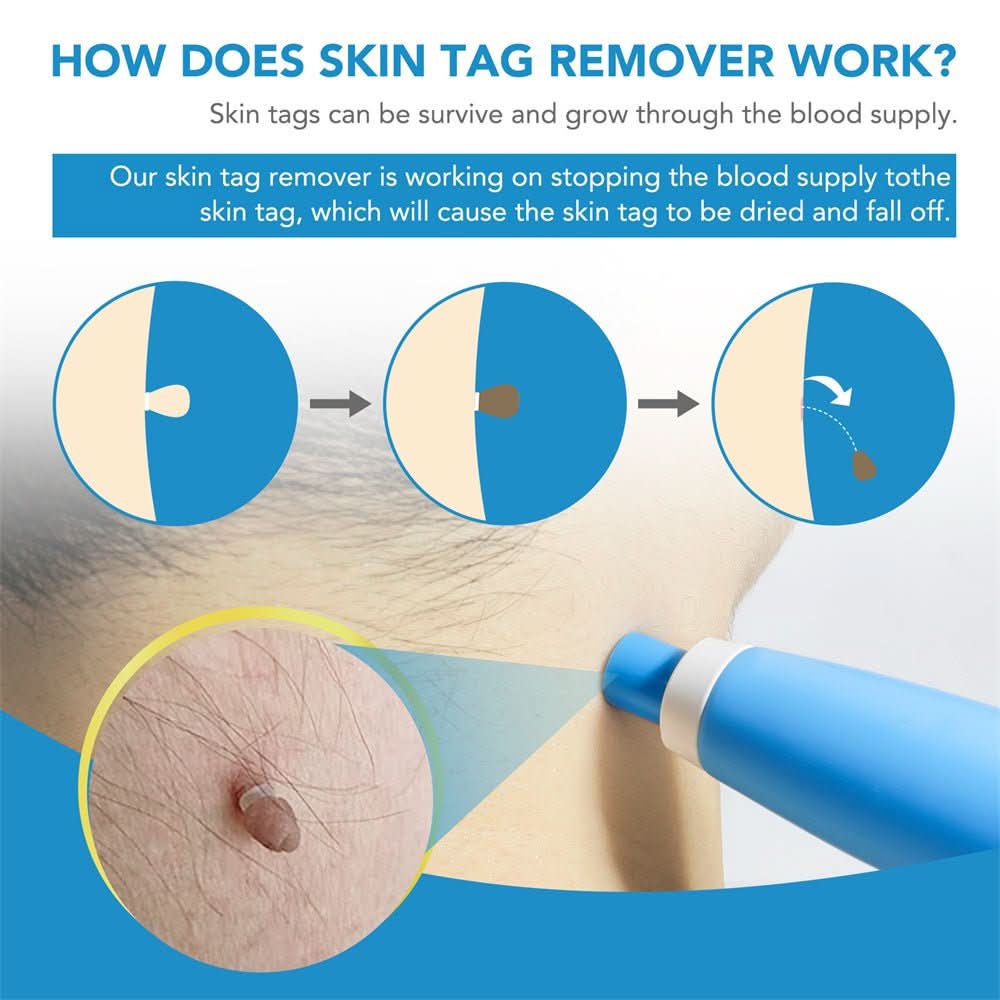 BowLift | Skin spot remover for warts & skin tags