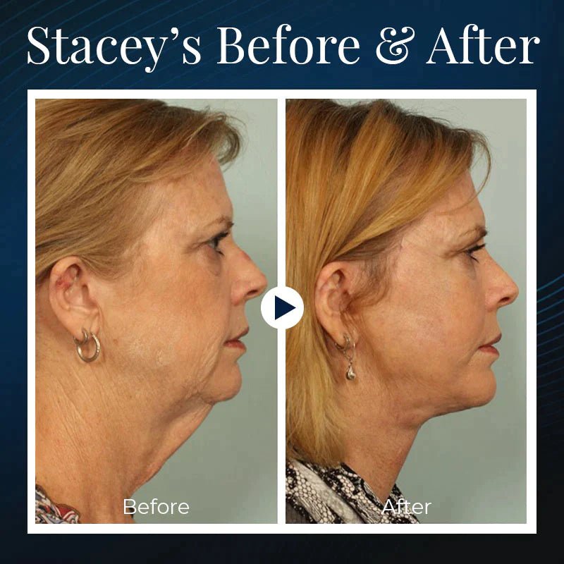 BowLift | BeautyRest+ Sleeping V-Face Beauty Device