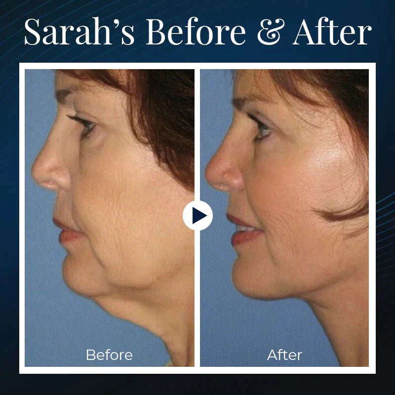 BowLift | BeautyRest+ Sleeping V-Face Beauty Device