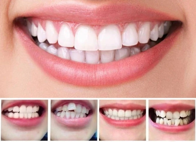 BowLift | Invisible Dental Realignment Tray