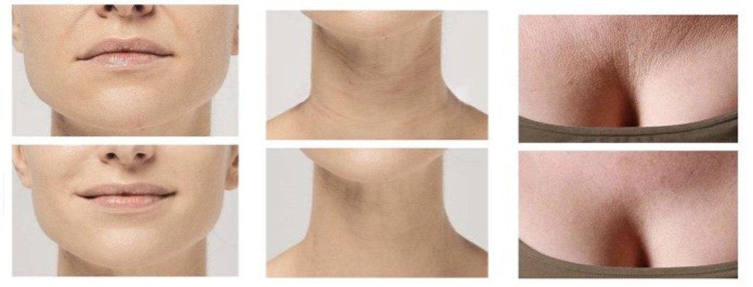 BowLift | Anti-Wrinkle Silicone Pads