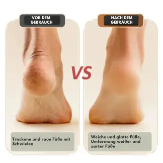 BowLift | Electric callus remover for smooth feet